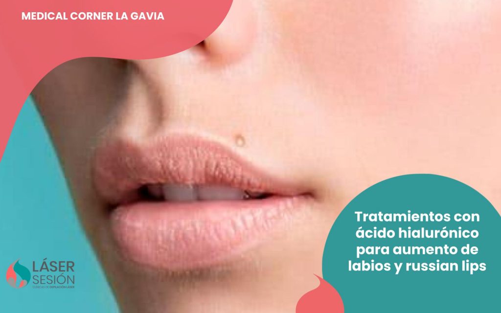 Aumentos de labios con ácido hialurónico y russian lips